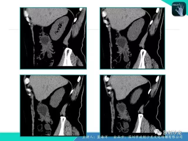 【病例】肠囊肿型重复畸形1例CT
