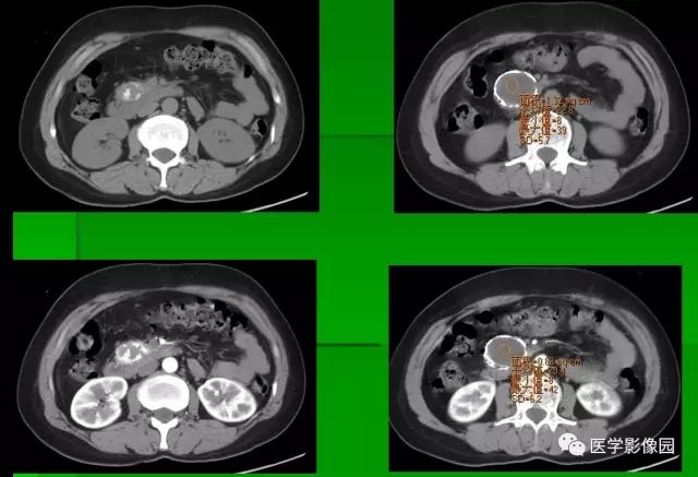 【病例】胰腺实性假乳头状瘤1例CT
