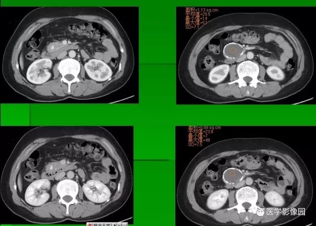 【病例】胰腺实性假乳头状瘤1例CT
