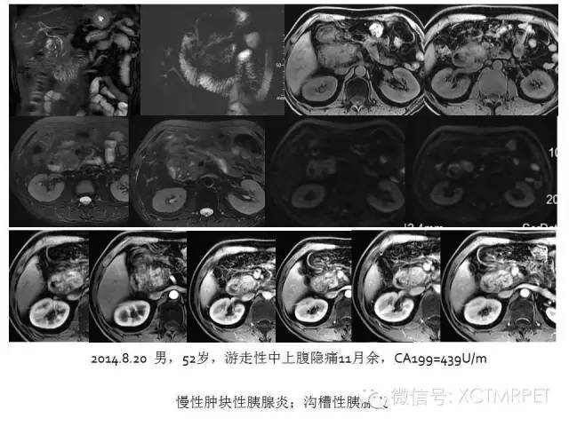 【PPT】肿块性胰腺炎影像诊断和鉴别诊断