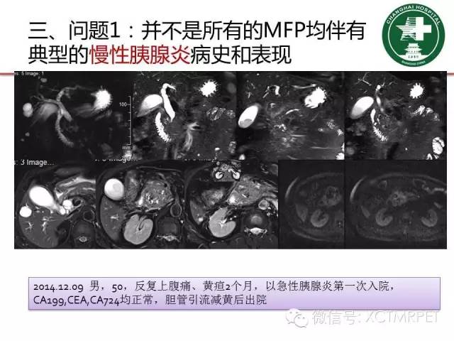 【PPT】肿块性胰腺炎影像诊断和鉴别诊断