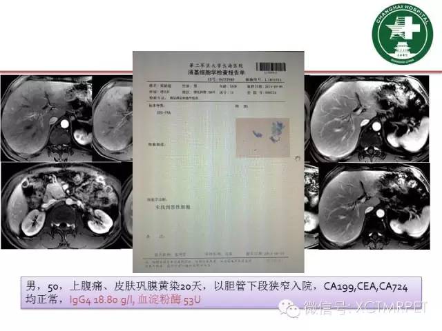 【PPT】肿块性胰腺炎影像诊断和鉴别诊断