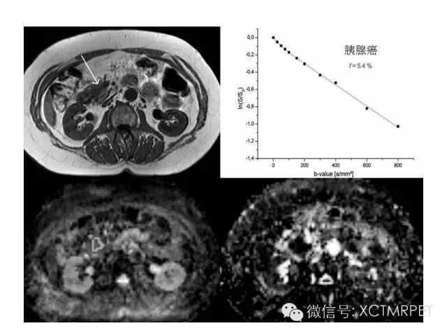 【PPT】肿块性胰腺炎影像诊断和鉴别诊断