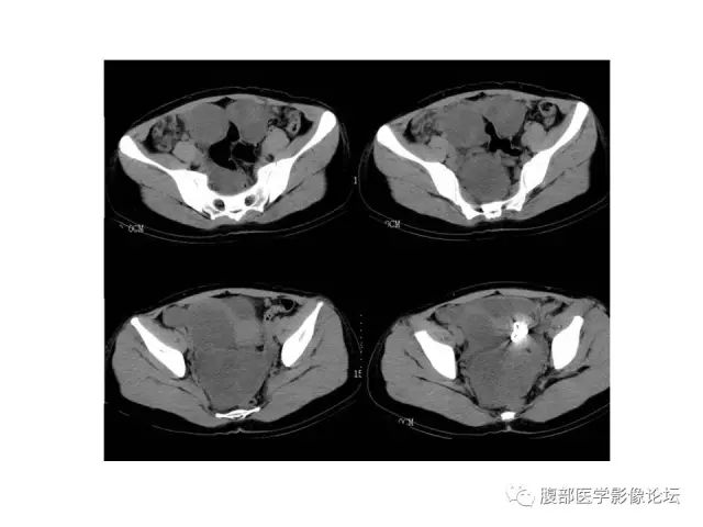 【病例】腹膜间皮瘤1例CT影像表现