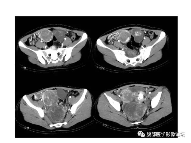 【病例】腹膜间皮瘤1例CT影像表现