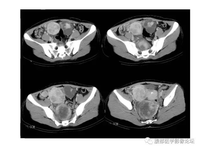 【病例】腹膜间皮瘤1例CT影像表现