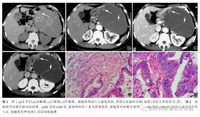 【病例】胰腺囊性病变1例CT影像诊断思维
