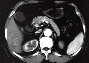 【病例】肝多发海绵状血管瘤1例CT