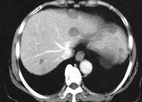 【病例】肝多发海绵状血管瘤1例CT