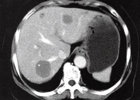 【病例】肝多发海绵状血管瘤1例CT