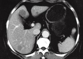 【病例】肝多发海绵状血管瘤1例CT