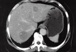 【病例】肝多发海绵状血管瘤1例CT