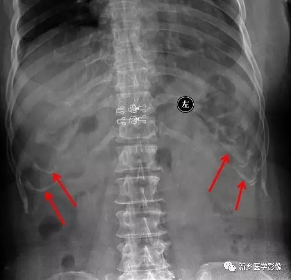 腹部平片看到高密度，你能想到这30种疾病吗？