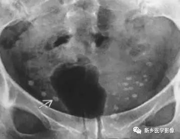 腹部平片看到高密度，你能想到这30种疾病吗？
