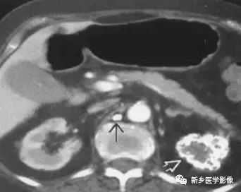 腹部平片看到高密度，你能想到这30种疾病吗？