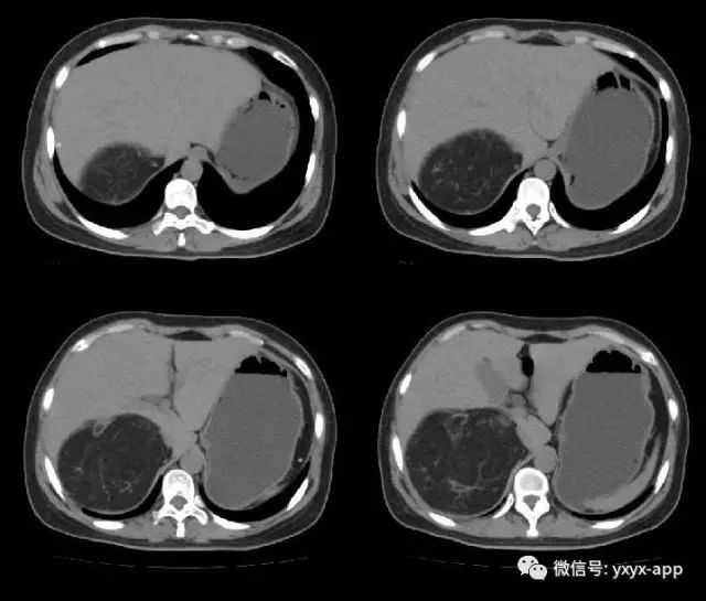 【病例】肾脏血管平滑肌脂肪瘤1例CT