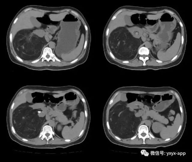 【病例】肾脏血管平滑肌脂肪瘤1例CT