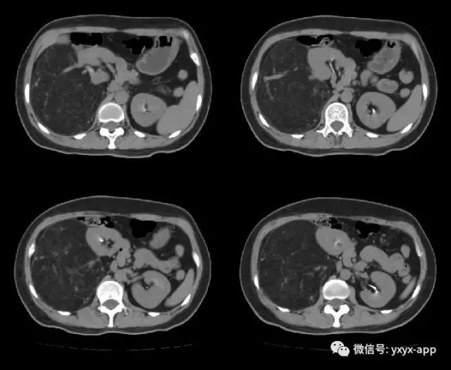 【病例】肾脏血管平滑肌脂肪瘤1例CT