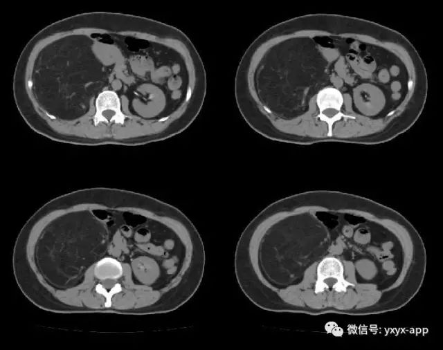 【病例】肾脏血管平滑肌脂肪瘤1例CT