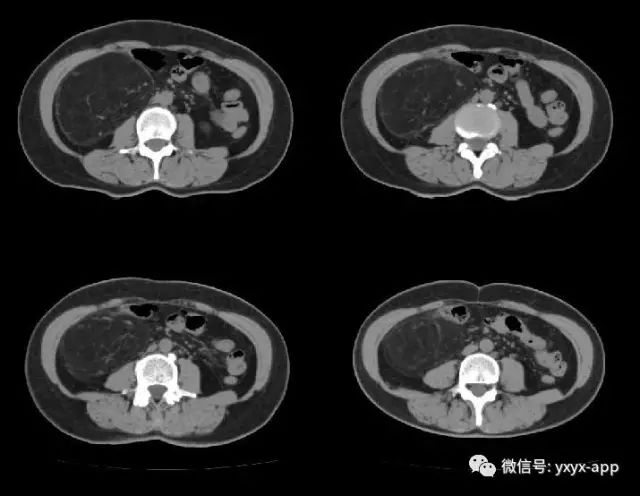 【病例】肾脏血管平滑肌脂肪瘤1例CT