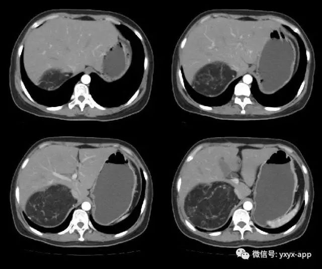 【病例】肾脏血管平滑肌脂肪瘤1例CT