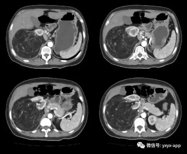 【病例】肾脏血管平滑肌脂肪瘤1例CT
