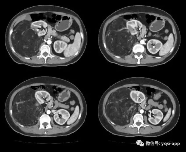 【病例】肾脏血管平滑肌脂肪瘤1例CT