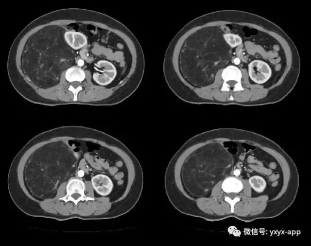 【病例】肾脏血管平滑肌脂肪瘤1例CT