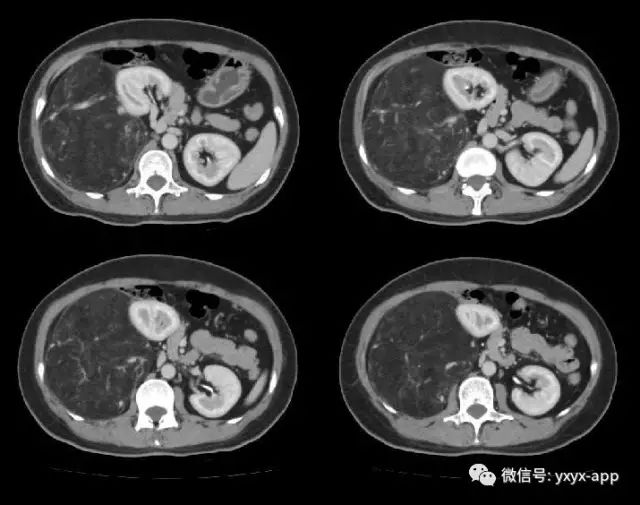 【病例】肾脏血管平滑肌脂肪瘤1例CT