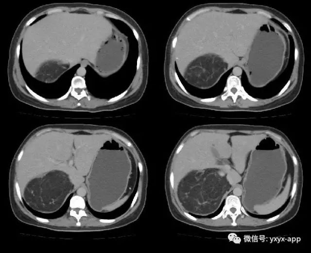 【病例】肾脏血管平滑肌脂肪瘤1例CT