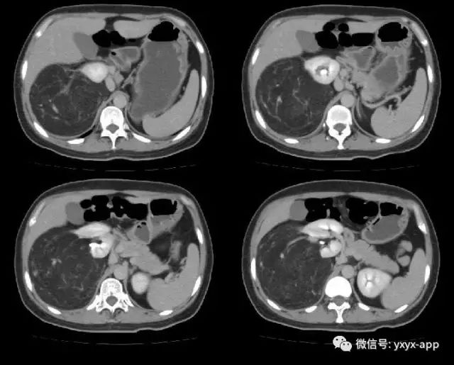 【病例】肾脏血管平滑肌脂肪瘤1例CT