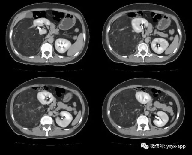 【病例】肾脏血管平滑肌脂肪瘤1例CT