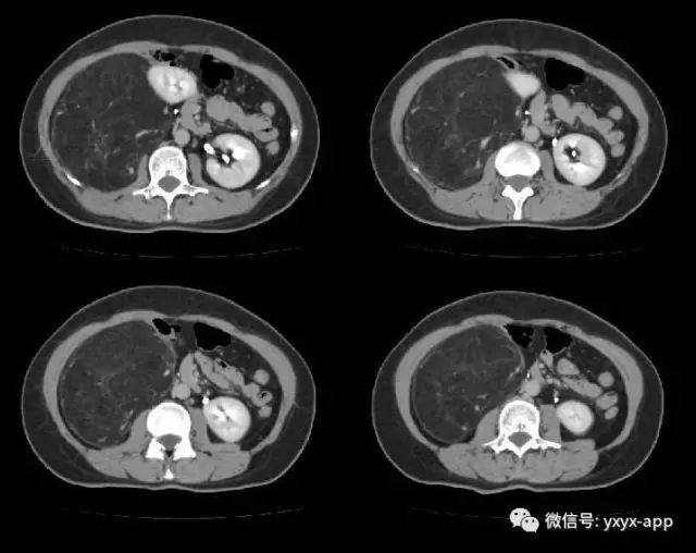 【病例】肾脏血管平滑肌脂肪瘤1例CT