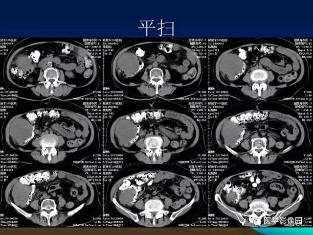 【病例】升结肠神经内分泌肿瘤1例CT影像表现