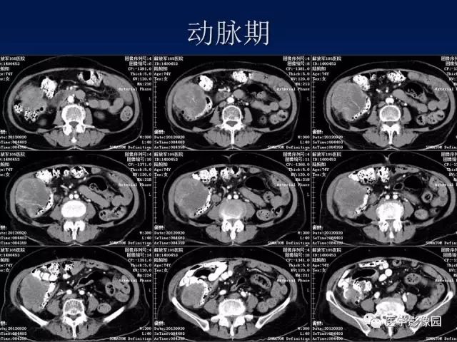 【病例】升结肠神经内分泌肿瘤1例CT影像表现