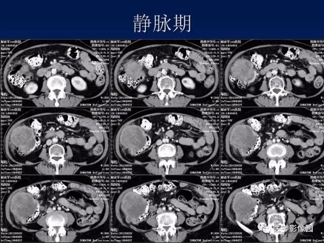 【病例】升结肠神经内分泌肿瘤1例CT影像表现