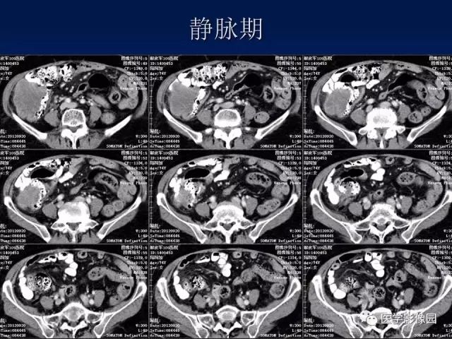 【病例】升结肠神经内分泌肿瘤1例CT影像表现