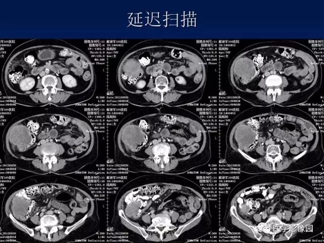 【病例】升结肠神经内分泌肿瘤1例CT影像表现