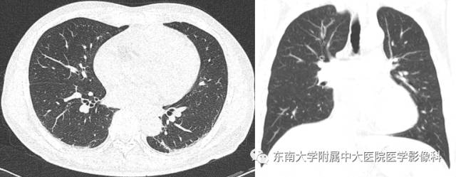 【病例】肝淋巴瘤1例CT影像表现