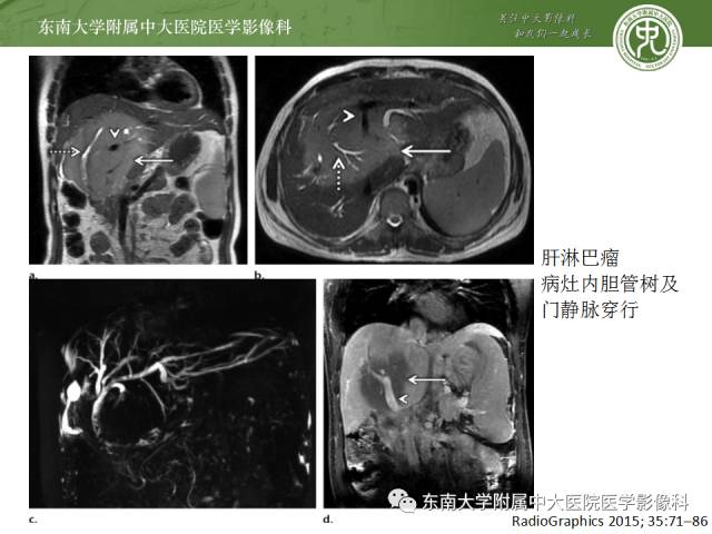【病例】肝淋巴瘤1例CT影像表现