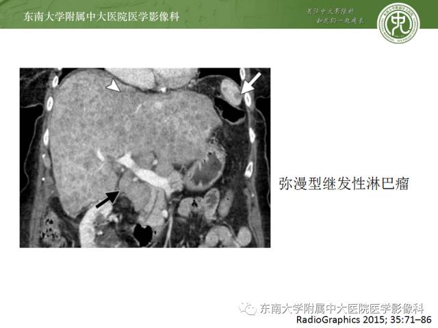 【病例】肝淋巴瘤1例CT影像表现