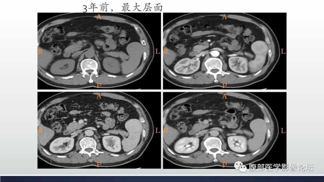 【病例】脾脏窦岸细胞血管瘤2例影像诊断-14