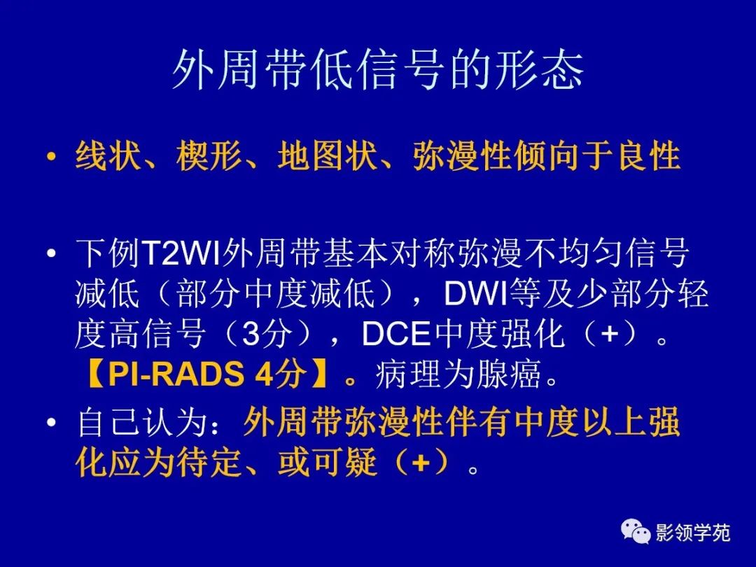 【PPT】前列腺癌MRI诊断再认识-74