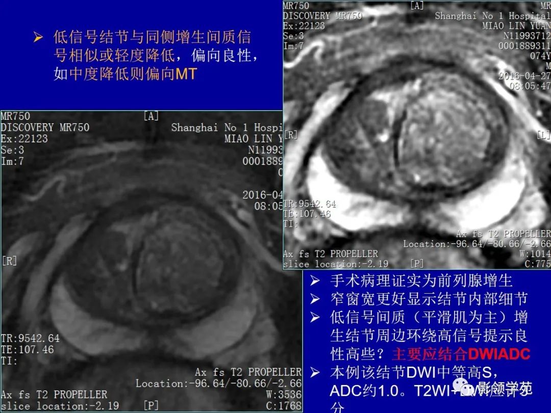 【PPT】前列腺癌MRI诊断再认识-83