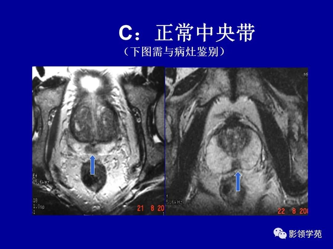 【PPT】前列腺癌MRI诊断再认识-140