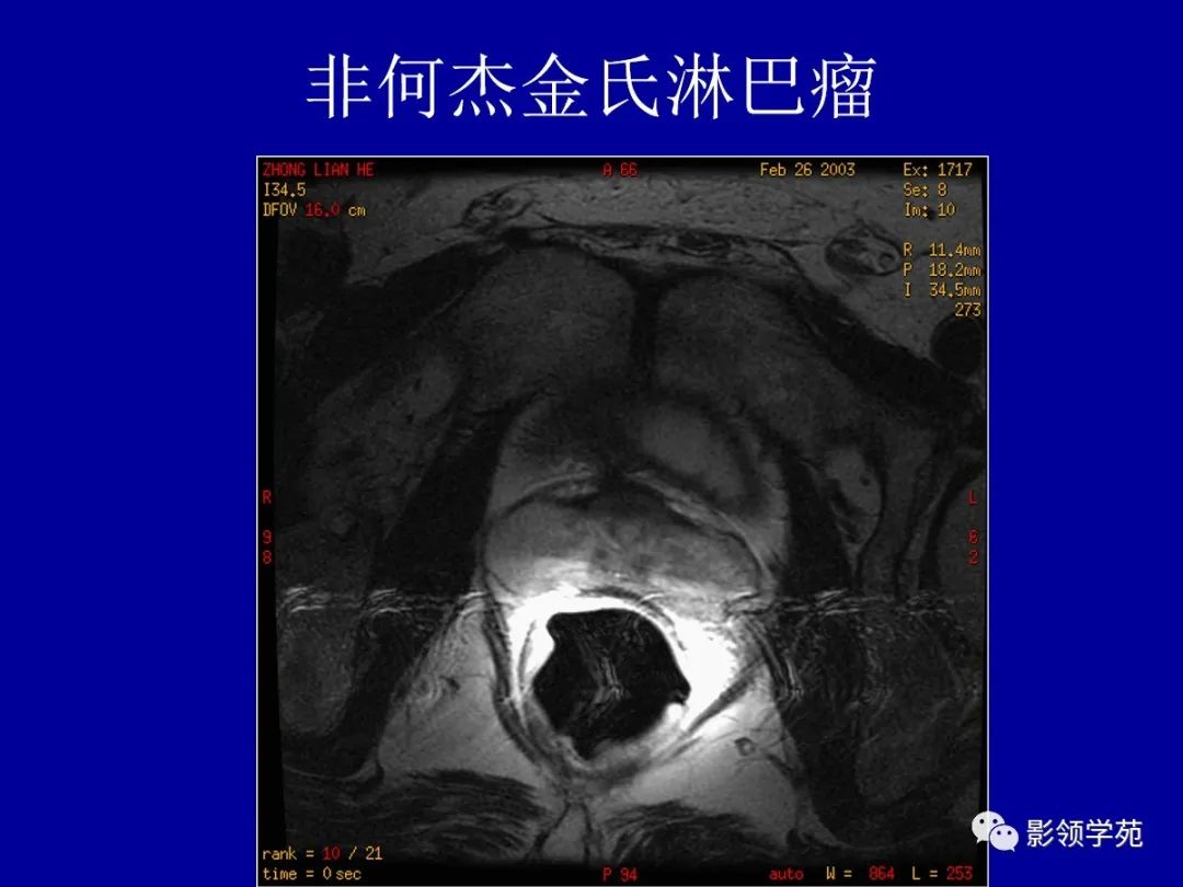 【PPT】前列腺癌MRI诊断再认识-156
