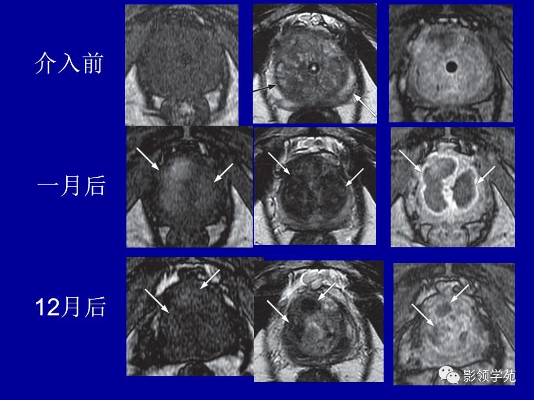 【PPT】前列腺癌MRI诊断再认识-171