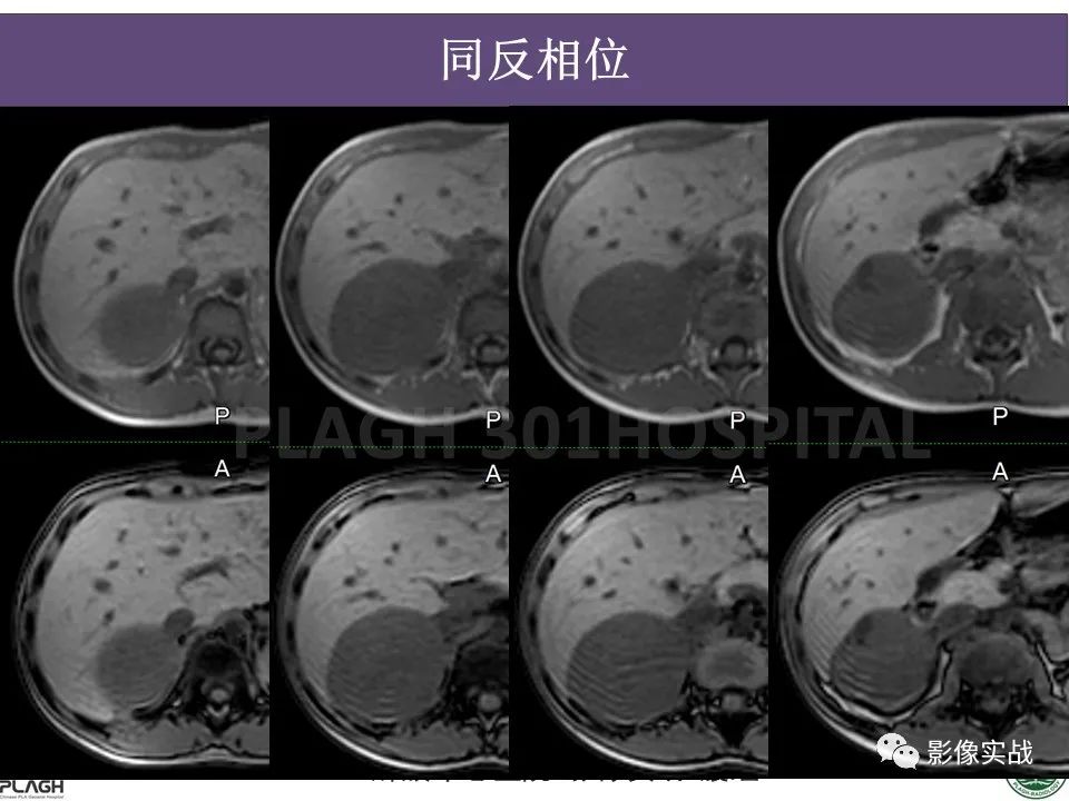 【病例】节细胞神经母细胞瘤1例CT解析思路-8