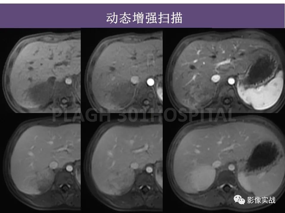 【病例】节细胞神经母细胞瘤1例CT解析思路-11