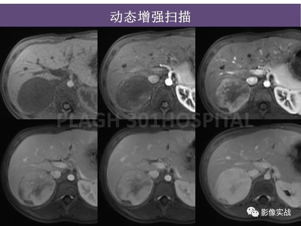 【病例】节细胞神经母细胞瘤1例CT解析思路-12